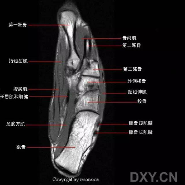 影像PPT - 踝关节韧带大体解剖及断层解剖高清图解-34 影像PPT - 踝关节韧带大体解剖及断层解剖高清图解-34