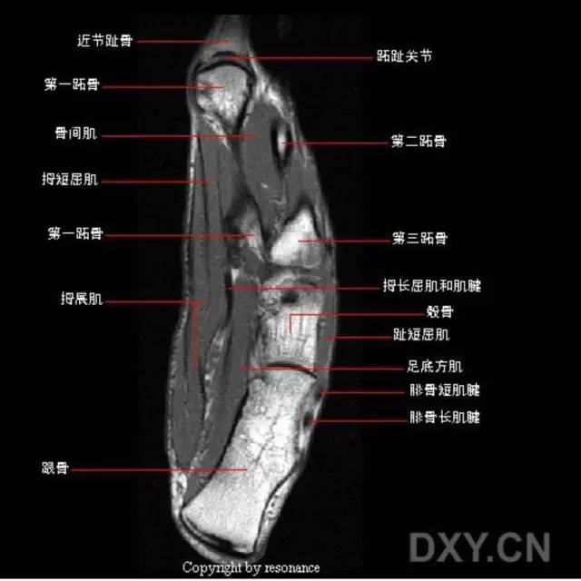 影像PPT - 踝关节韧带大体解剖及断层解剖高清图解-35 影像PPT - 踝关节韧带大体解剖及断层解剖高清图解-35