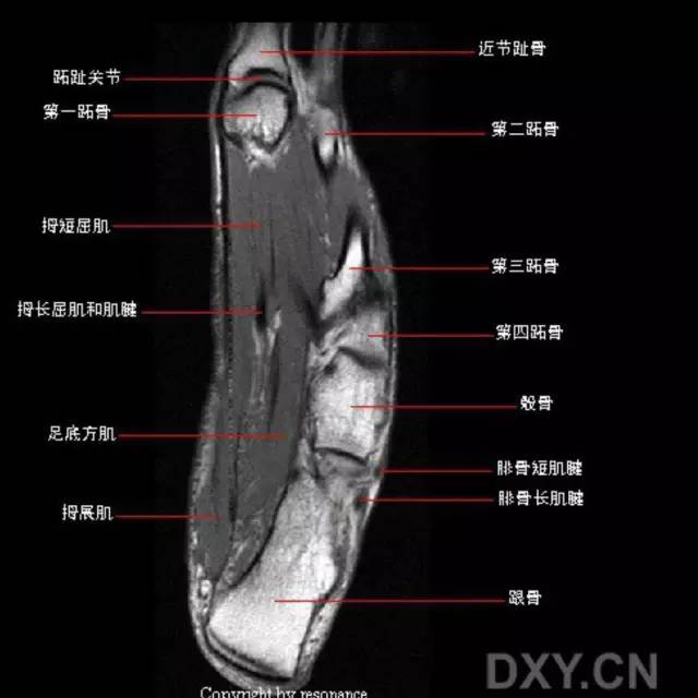 影像PPT - 踝关节韧带大体解剖及断层解剖高清图解-36 影像PPT - 踝关节韧带大体解剖及断层解剖高清图解-36