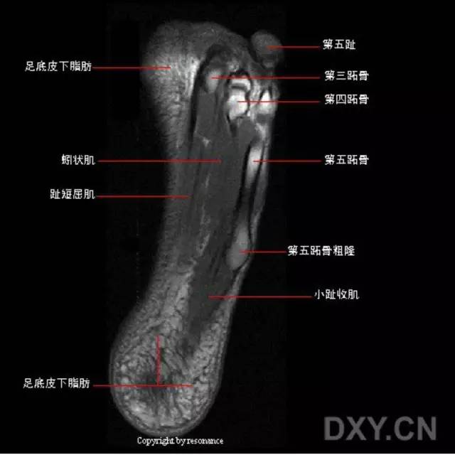 影像PPT - 踝关节韧带大体解剖及断层解剖高清图解-37 影像PPT - 踝关节韧带大体解剖及断层解剖高清图解-37