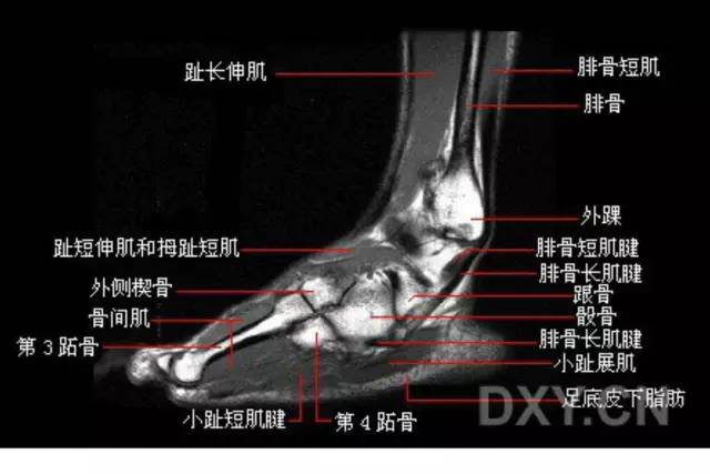 影像PPT - 踝关节韧带大体解剖及断层解剖高清图解-38 影像PPT - 踝关节韧带大体解剖及断层解剖高清图解-38