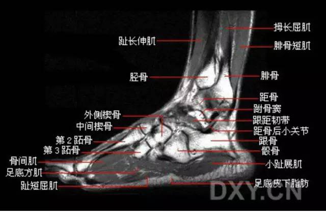 影像PPT - 踝关节韧带大体解剖及断层解剖高清图解-39 影像PPT - 踝关节韧带大体解剖及断层解剖高清图解-39