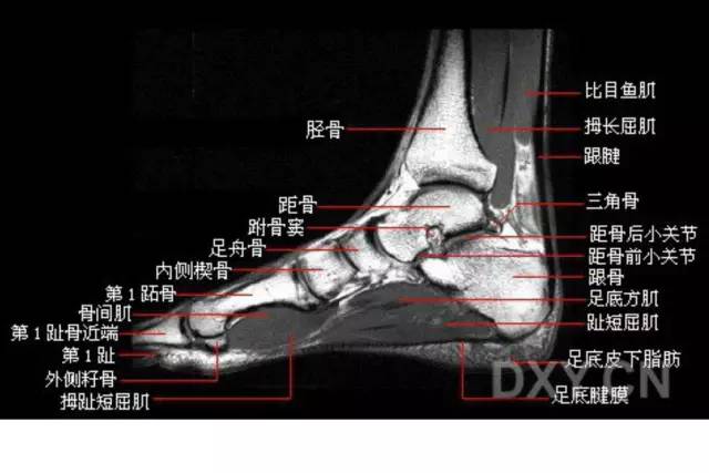 影像PPT - 踝关节韧带大体解剖及断层解剖高清图解-43 影像PPT - 踝关节韧带大体解剖及断层解剖高清图解-43
