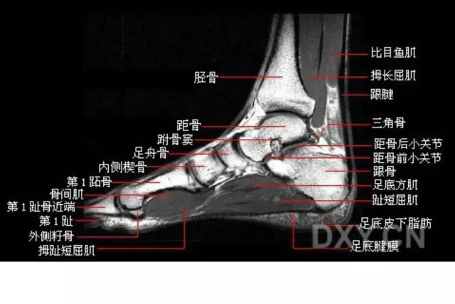 影像PPT - 踝关节韧带大体解剖及断层解剖高清图解-44 影像PPT - 踝关节韧带大体解剖及断层解剖高清图解-44