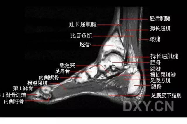 影像PPT - 踝关节韧带大体解剖及断层解剖高清图解-45 影像PPT - 踝关节韧带大体解剖及断层解剖高清图解-45