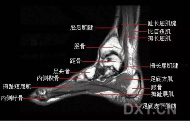 影像PPT - 踝关节韧带大体解剖及断层解剖高清图解-46 影像PPT - 踝关节韧带大体解剖及断层解剖高清图解-46