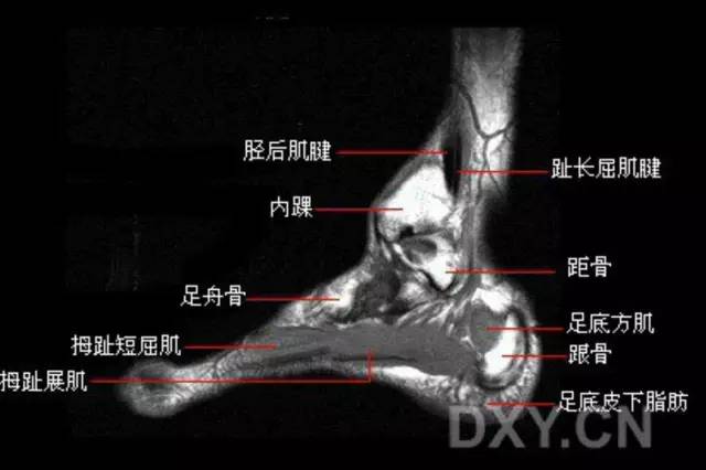 影像PPT - 踝关节韧带大体解剖及断层解剖高清图解-47 影像PPT - 踝关节韧带大体解剖及断层解剖高清图解-47