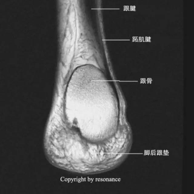 影像PPT - 踝关节韧带大体解剖及断层解剖高清图解-49 影像PPT - 踝关节韧带大体解剖及断层解剖高清图解-49