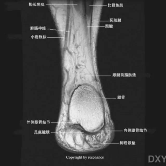 影像PPT - 踝关节韧带大体解剖及断层解剖高清图解-50 影像PPT - 踝关节韧带大体解剖及断层解剖高清图解-50