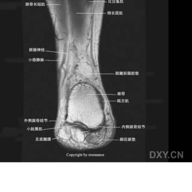 影像PPT - 踝关节韧带大体解剖及断层解剖高清图解-51 影像PPT - 踝关节韧带大体解剖及断层解剖高清图解-51