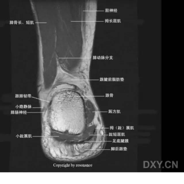 影像PPT - 踝关节韧带大体解剖及断层解剖高清图解-53 影像PPT - 踝关节韧带大体解剖及断层解剖高清图解-53