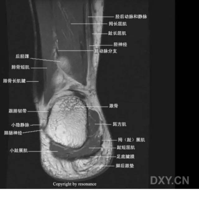 影像PPT - 踝关节韧带大体解剖及断层解剖高清图解-54 影像PPT - 踝关节韧带大体解剖及断层解剖高清图解-54