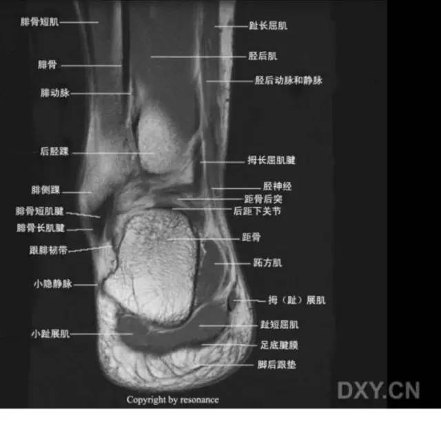 影像PPT - 踝关节韧带大体解剖及断层解剖高清图解-55 影像PPT - 踝关节韧带大体解剖及断层解剖高清图解-55