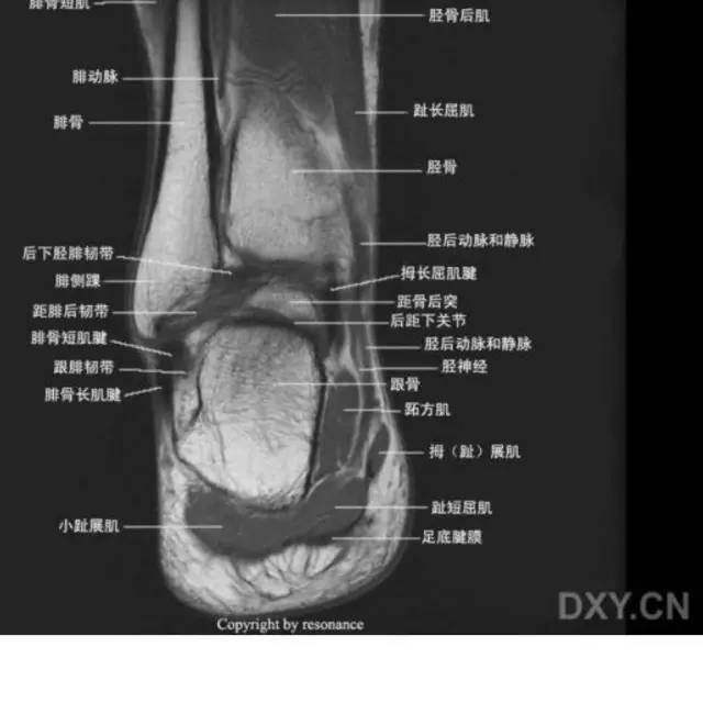 影像PPT - 踝关节韧带大体解剖及断层解剖高清图解-56 影像PPT - 踝关节韧带大体解剖及断层解剖高清图解-56