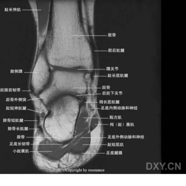 影像PPT - 踝关节韧带大体解剖及断层解剖高清图解-57 影像PPT - 踝关节韧带大体解剖及断层解剖高清图解-57