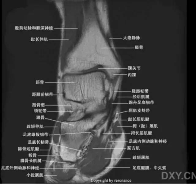 影像PPT - 踝关节韧带大体解剖及断层解剖高清图解-60 影像PPT - 踝关节韧带大体解剖及断层解剖高清图解-60