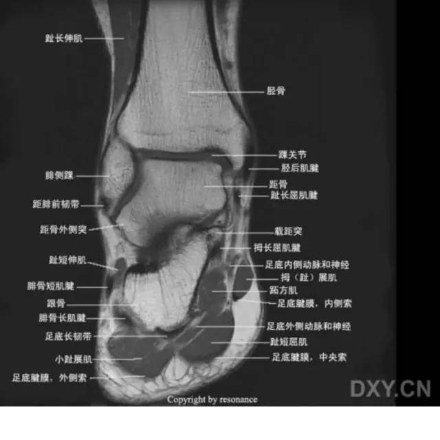 影像PPT - 踝关节韧带大体解剖及断层解剖高清图解-58 影像PPT - 踝关节韧带大体解剖及断层解剖高清图解-58