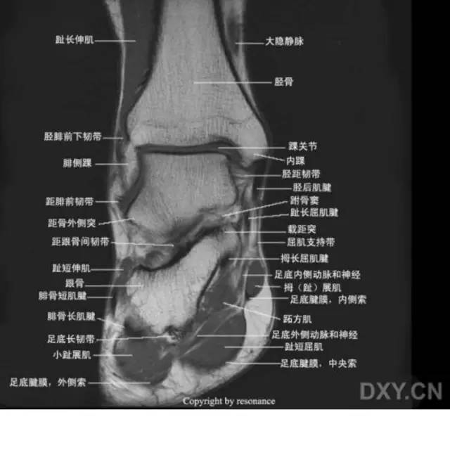 影像PPT - 踝关节韧带大体解剖及断层解剖高清图解-59 影像PPT - 踝关节韧带大体解剖及断层解剖高清图解-59