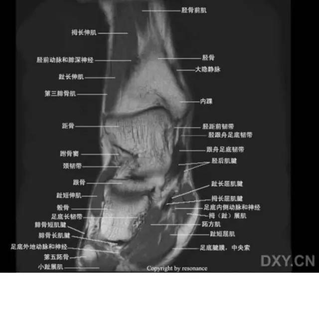 影像PPT - 踝关节韧带大体解剖及断层解剖高清图解-61 影像PPT - 踝关节韧带大体解剖及断层解剖高清图解-61