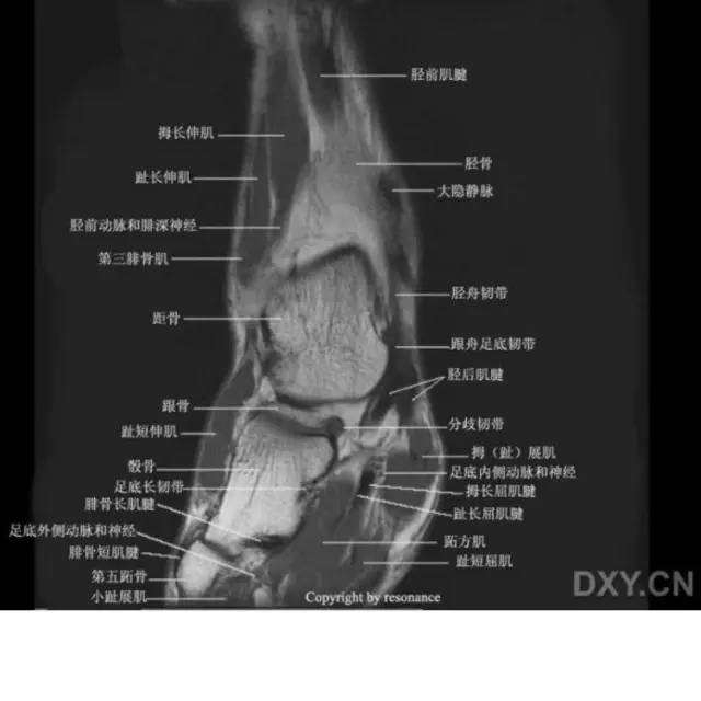 影像PPT - 踝关节韧带大体解剖及断层解剖高清图解-62 影像PPT - 踝关节韧带大体解剖及断层解剖高清图解-62