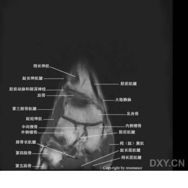 影像PPT - 踝关节韧带大体解剖及断层解剖高清图解-65 影像PPT - 踝关节韧带大体解剖及断层解剖高清图解-65