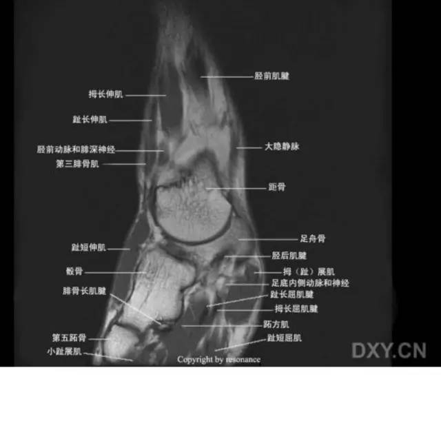 影像PPT - 踝关节韧带大体解剖及断层解剖高清图解-63 影像PPT - 踝关节韧带大体解剖及断层解剖高清图解-63