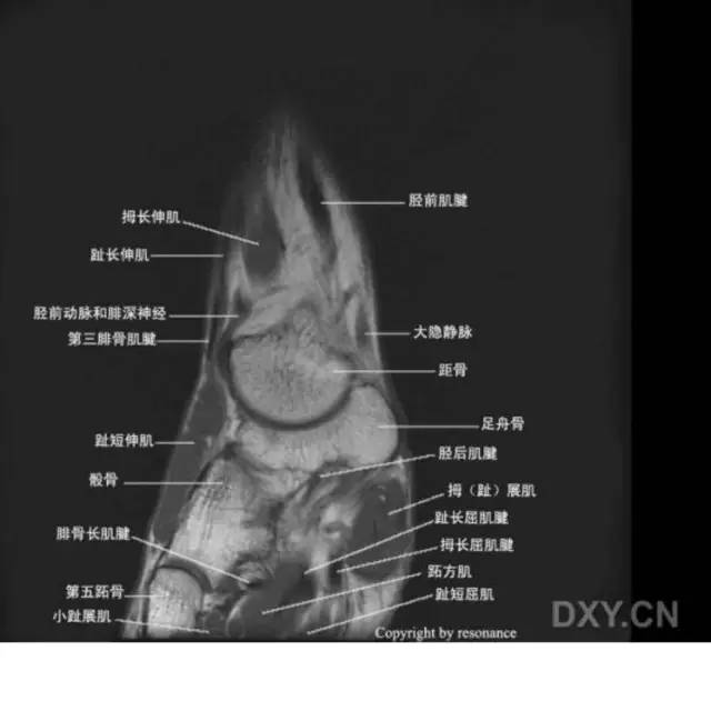 影像PPT - 踝关节韧带大体解剖及断层解剖高清图解-64 影像PPT - 踝关节韧带大体解剖及断层解剖高清图解-64