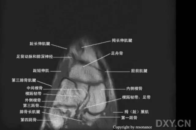 影像PPT - 踝关节韧带大体解剖及断层解剖高清图解-66 影像PPT - 踝关节韧带大体解剖及断层解剖高清图解-66