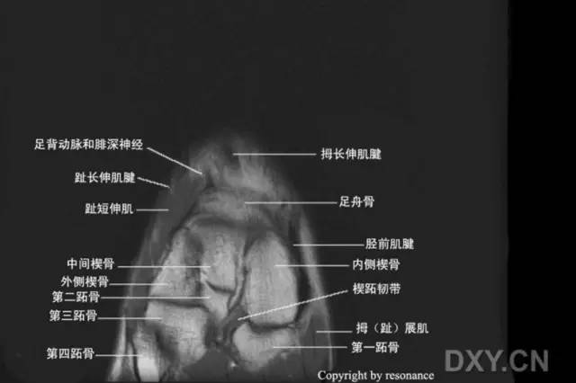 影像PPT - 踝关节韧带大体解剖及断层解剖高清图解-67 影像PPT - 踝关节韧带大体解剖及断层解剖高清图解-67