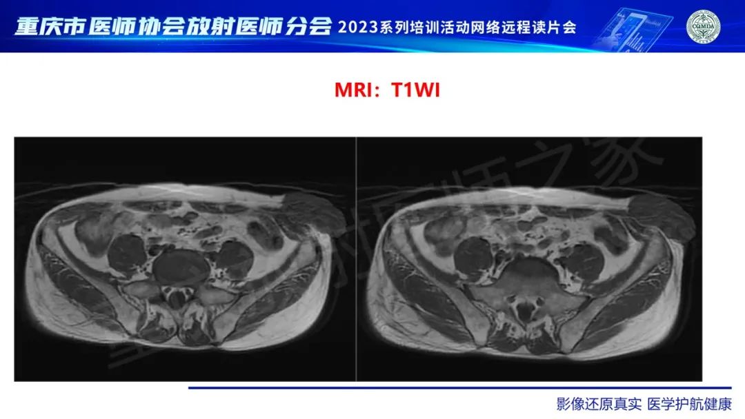 影像PPT - 【病例】腹壁隆突性皮肤纤维肉瘤1例MR影像-3