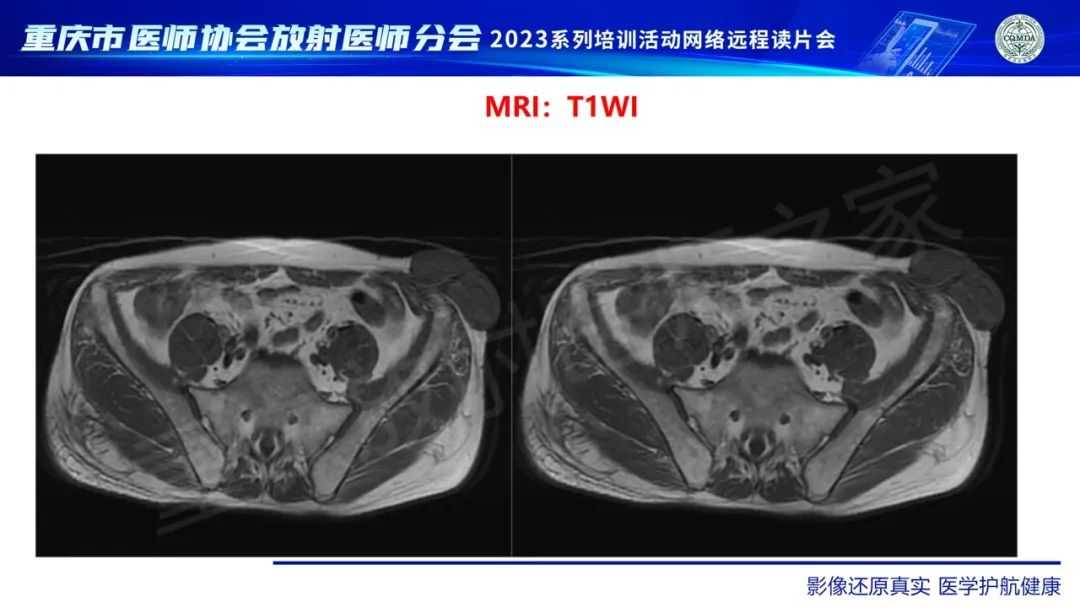 影像PPT - 【病例】腹壁隆突性皮肤纤维肉瘤1例MR影像-4