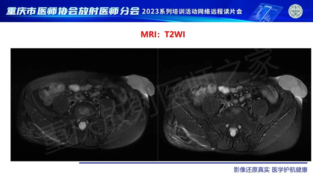 影像PPT - 【病例】腹壁隆突性皮肤纤维肉瘤1例MR影像-5