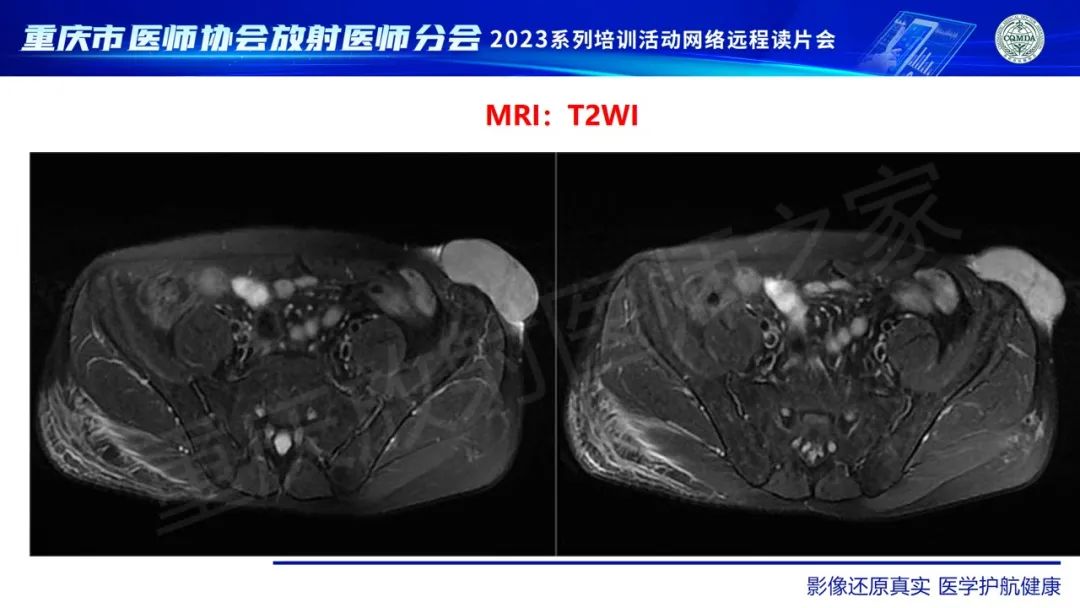 影像PPT - 【病例】腹壁隆突性皮肤纤维肉瘤1例MR影像-6