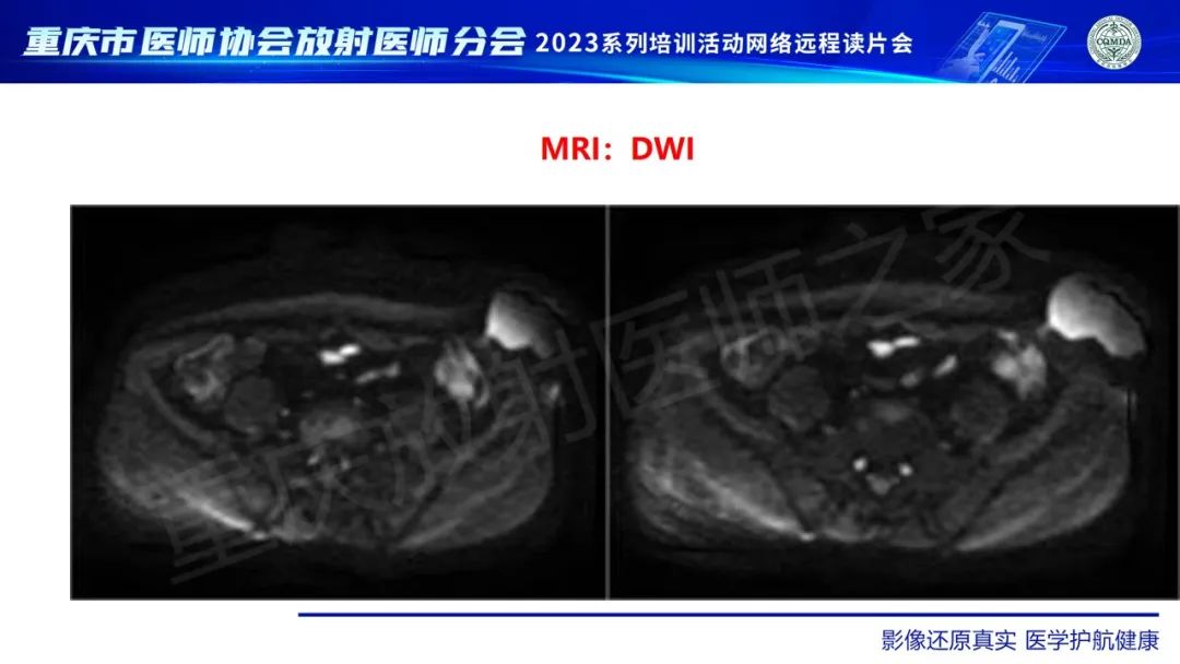 影像PPT - 【病例】腹壁隆突性皮肤纤维肉瘤1例MR影像-7