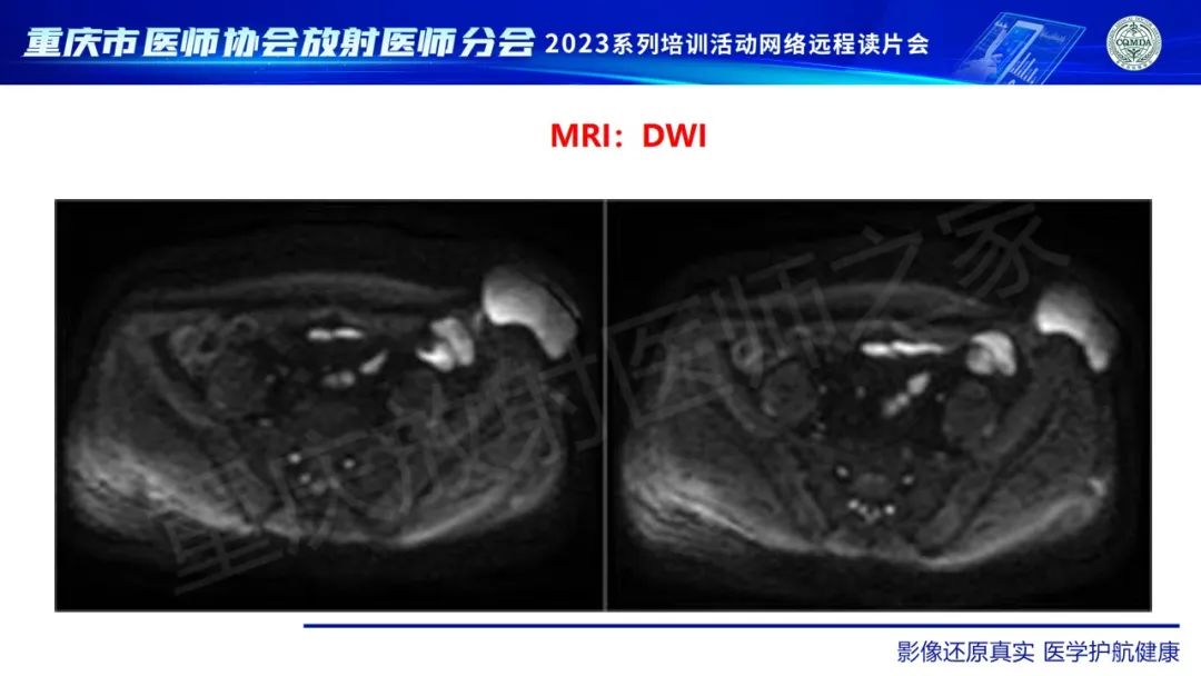 影像PPT - 【病例】腹壁隆突性皮肤纤维肉瘤1例MR影像-8