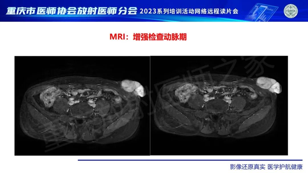 影像PPT - 【病例】腹壁隆突性皮肤纤维肉瘤1例MR影像-9