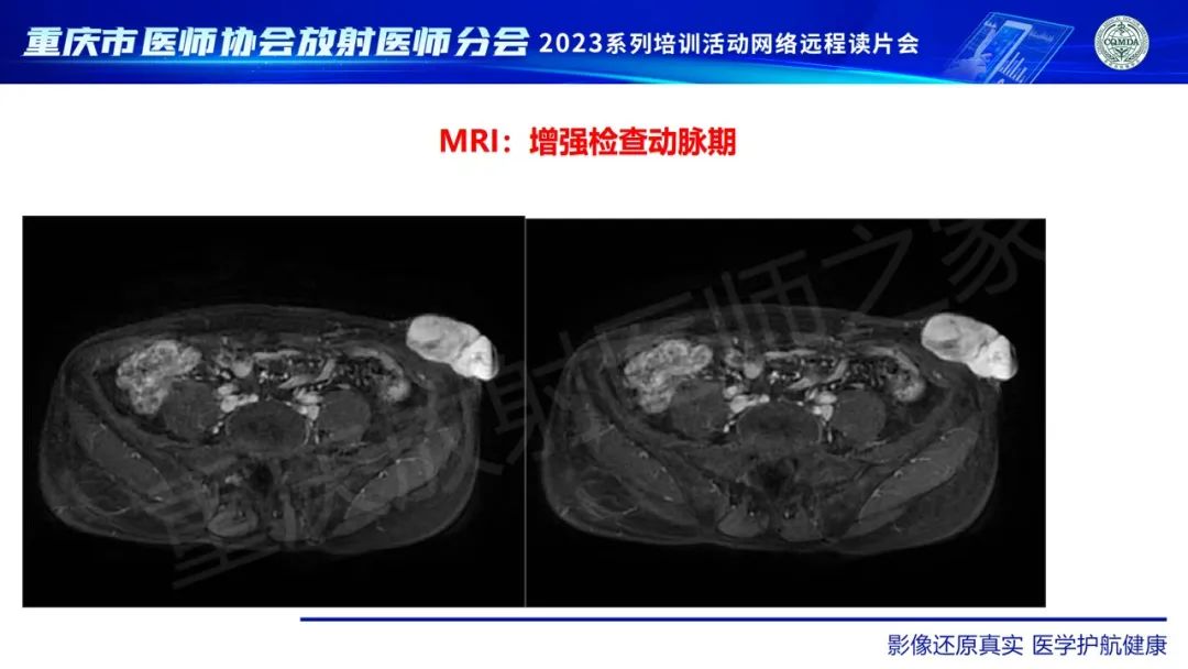 影像PPT - 【病例】腹壁隆突性皮肤纤维肉瘤1例MR影像-10