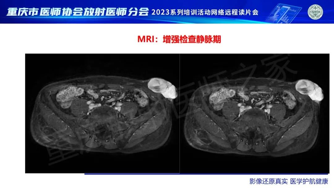 影像PPT - 【病例】腹壁隆突性皮肤纤维肉瘤1例MR影像-11