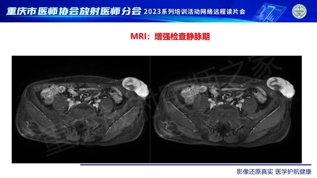 影像PPT - 【病例】腹壁隆突性皮肤纤维肉瘤1例MR影像-12