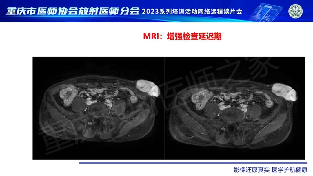 影像PPT - 【病例】腹壁隆突性皮肤纤维肉瘤1例MR影像-13