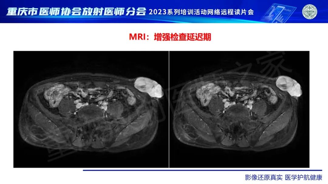 影像PPT - 【病例】腹壁隆突性皮肤纤维肉瘤1例MR影像-14