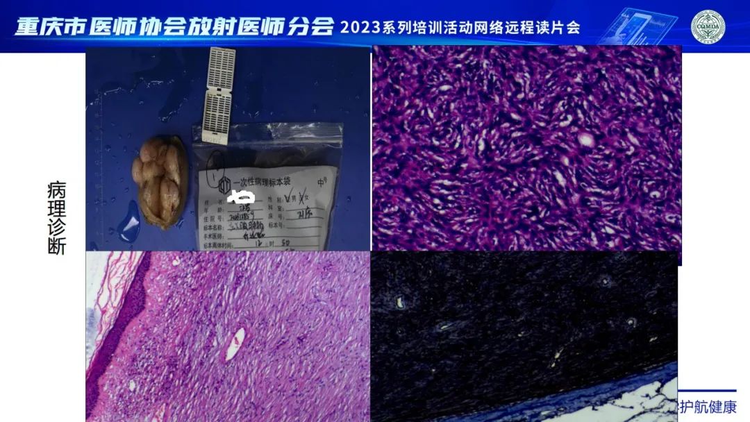 影像PPT - 【病例】腹壁隆突性皮肤纤维肉瘤1例MR影像-18