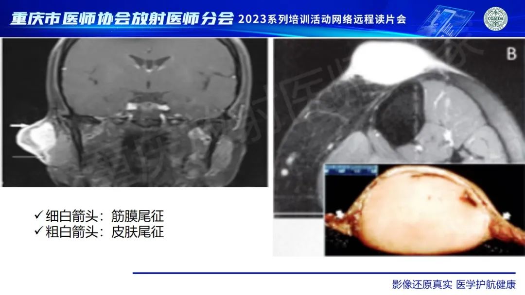 影像PPT - 【病例】腹壁隆突性皮肤纤维肉瘤1例MR影像-23