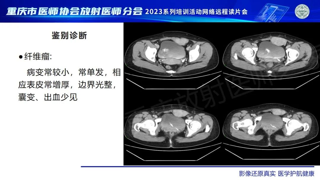 影像PPT - 【病例】腹壁隆突性皮肤纤维肉瘤1例MR影像-24