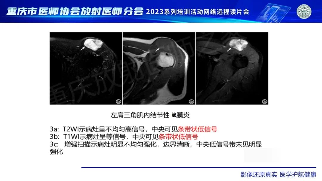 影像PPT - 【病例】腹壁隆突性皮肤纤维肉瘤1例MR影像-26