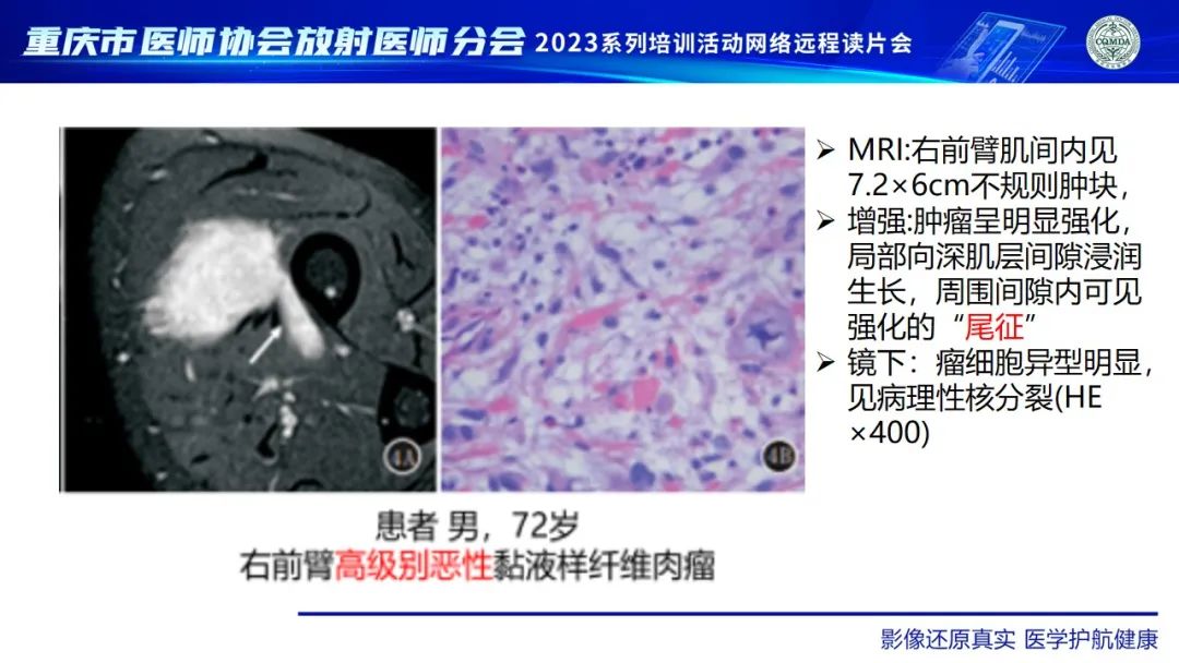 影像PPT - 【病例】腹壁隆突性皮肤纤维肉瘤1例MR影像-28
