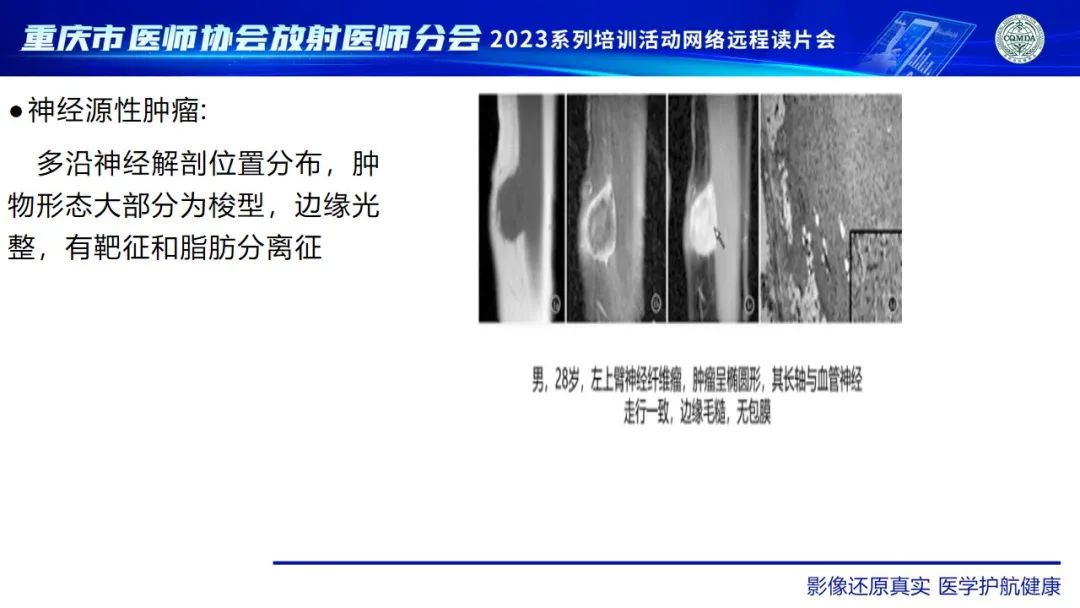影像PPT - 【病例】腹壁隆突性皮肤纤维肉瘤1例MR影像-29
