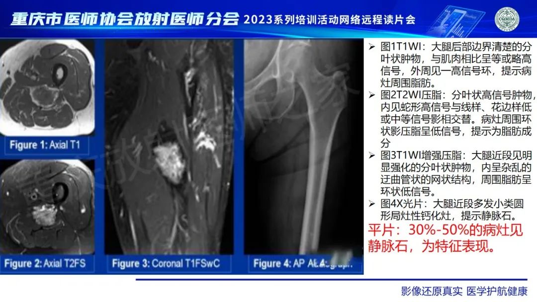 影像PPT - 【病例】腹壁隆突性皮肤纤维肉瘤1例MR影像-31