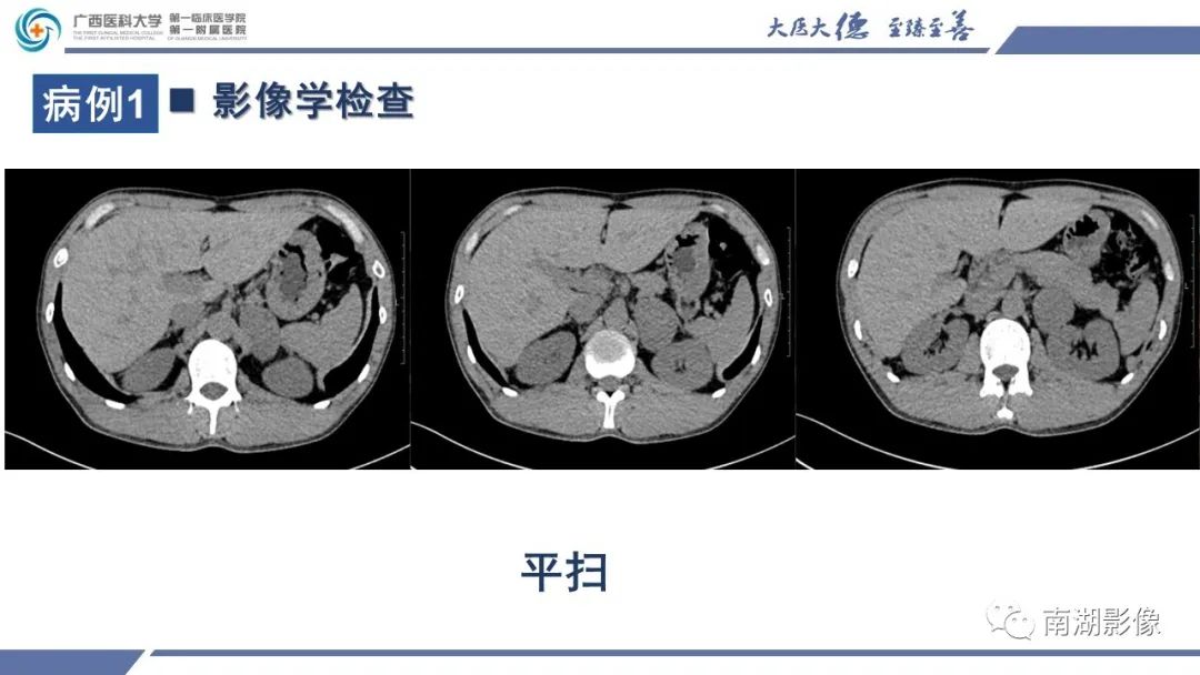 影像PPT - 【PPT】肾上腺节细胞神经瘤-3