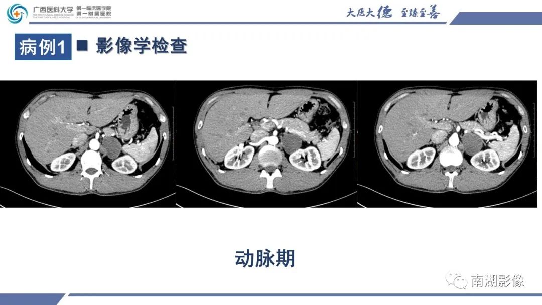 影像PPT - 【PPT】肾上腺节细胞神经瘤-4